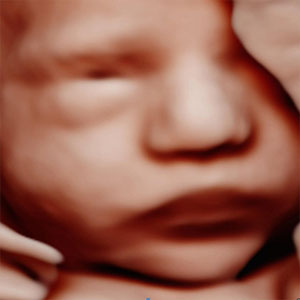 Early 3D ultrasound 15 weeks
